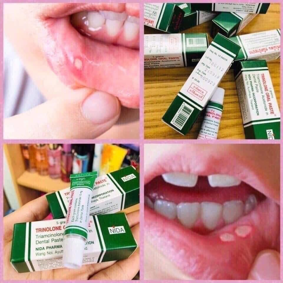 Kem nhiệt miệng thái lan nida trinolone