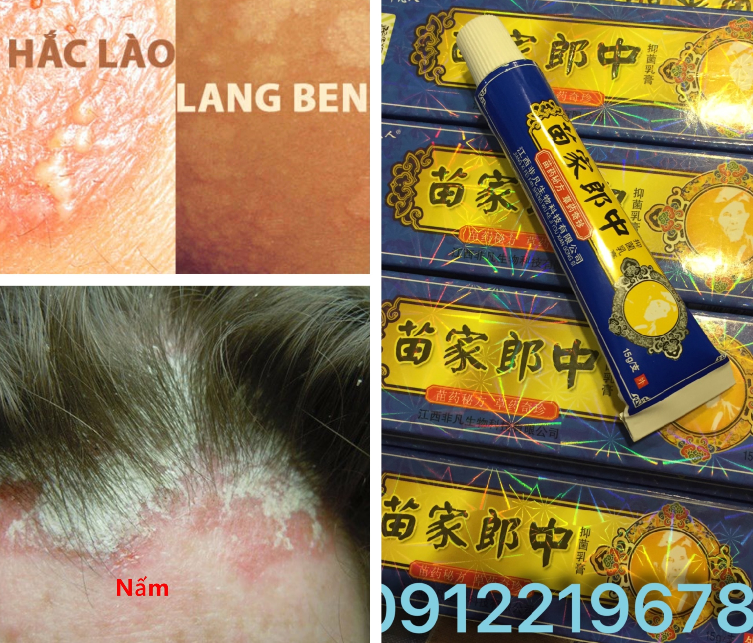 CHUYÊN NẤM DA HẮC LÀO LANG BEN TỔ ĐỈA