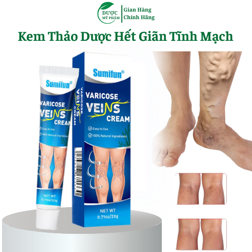 kem hết  giãn tĩnh mạch Chiết xuất thảo dược loại bỏ chứng giãn tĩnh mạch ở chân và tay 20g