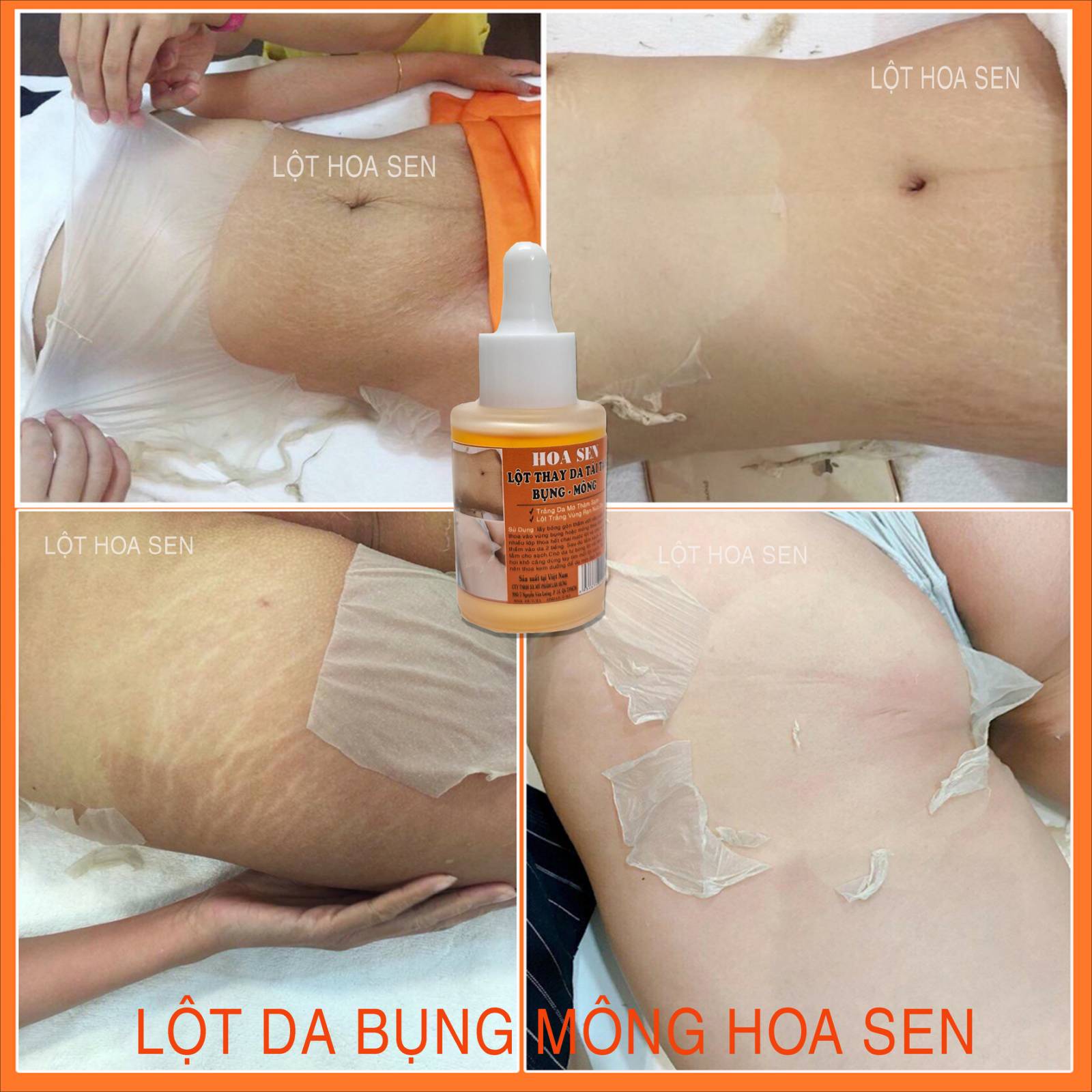 Lột thay da tái tạo bụng mông bẹn hoa sen