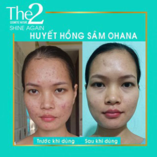 Huyết hồng sâm ohana sạch mụn thâm sẹo rỗ - giá hủy diệt siêu deal giảm 50%