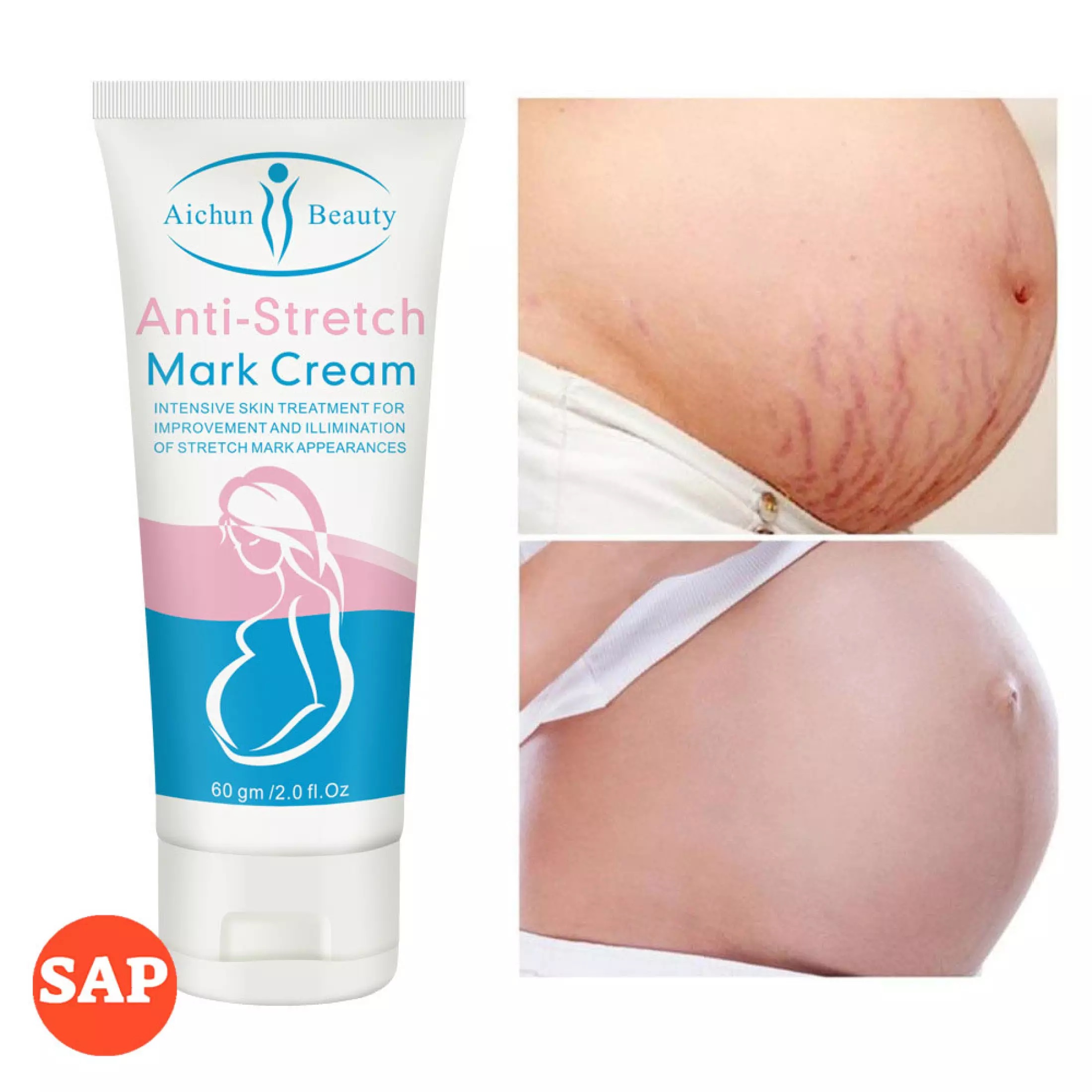 3,200+ Stretch Mark Stock Photos, Pictures & Royalty-Free Images - iStock | Stretch  mark cream, Stretch mark treatment, Stretch mark close up