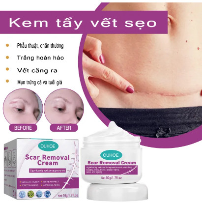 Kem trị sẹo Vết sẹo hỗ trợ trị sẹo, mờ thâm, rạn da Giảm Mụn bỏng phẫu thuật scar esthetique thuốc điều Trị