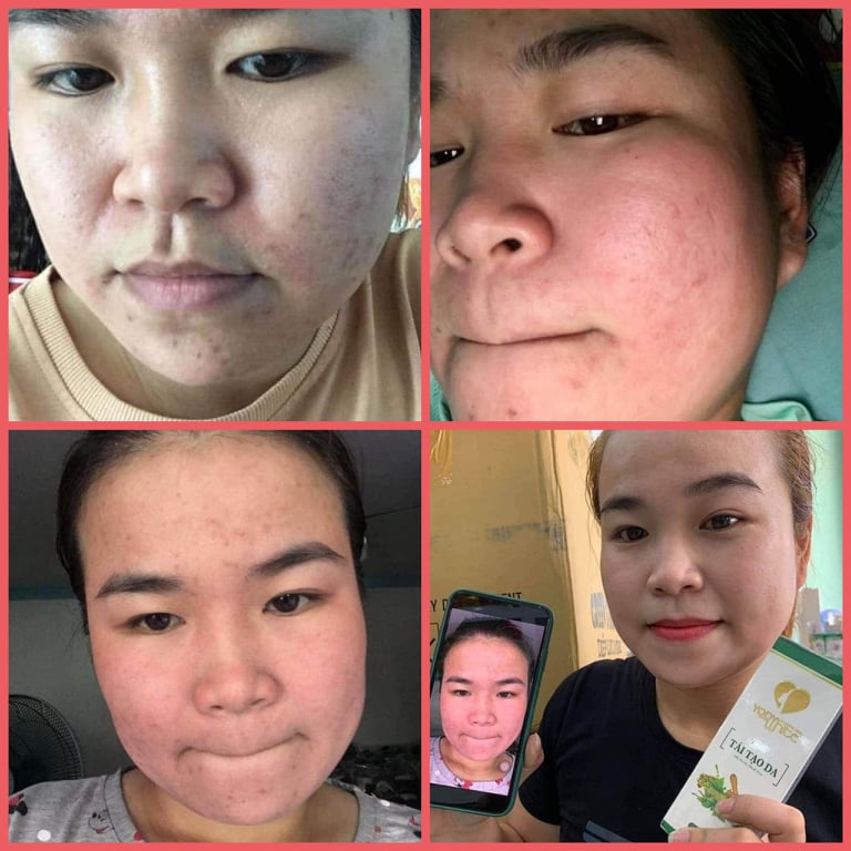 -thảo dược tái tạo da phương anh