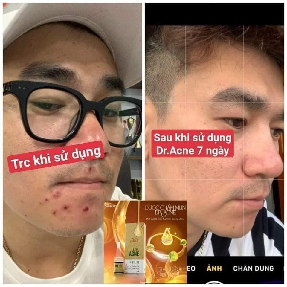 [Serum Gom khô cồi, giảm mụn, mờ thâm sau mụn, 100% Feedback khách tin dùng hiệu quả] Serum Chấm Mụn Hải âu việt