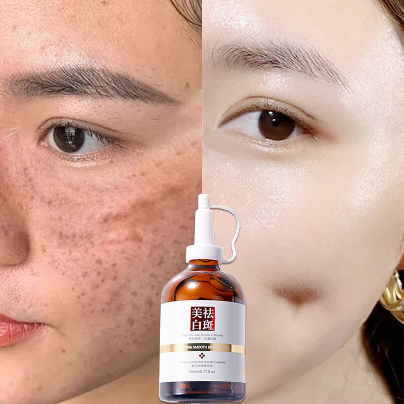 Serum dưỡng trắng da loại bỏ tàn nhang nám 100mlNiacinamide nám tàn nhang làm trắng căng bóng da chống lão hóa nám tàn nhang