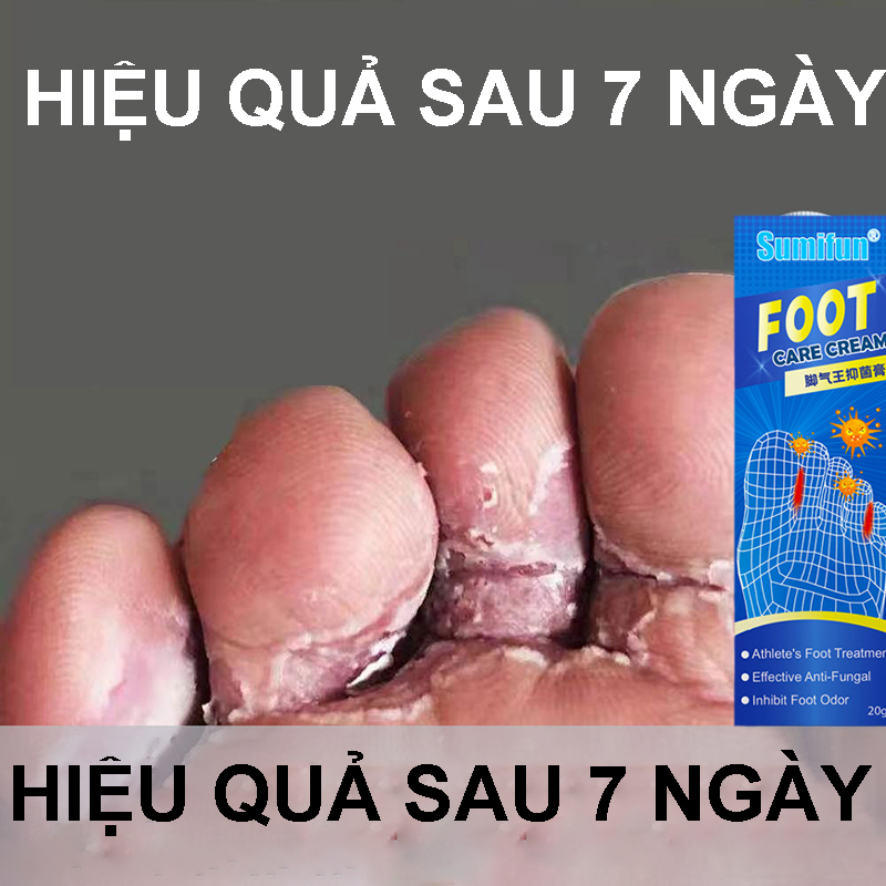 Kem loại bỏ nấm tay chân, 20g, chống ngứa, bong tróc da, nứt nẻ, gel bôi da, dưỡng ẩm tay chân, bảo vệ da, chăm sóc da mùa đông