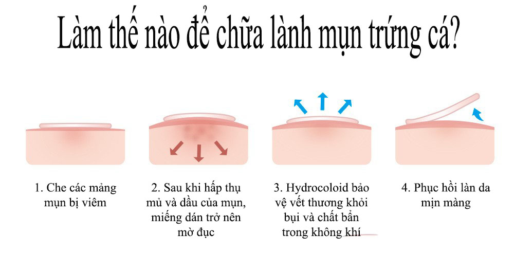 BREYLEE Miếng Dán Tri Mụn Đầu Đen Tri Thâm Mụn Trứng Cá Lột Mụn Đậu Đen Làm Mờ Vết Thâm Do Mụn (Dùng Cho Buổi Tối) FACIAL MASK 22 PATCHES NIGHT USE ACNE PIMPLE PATCH 7