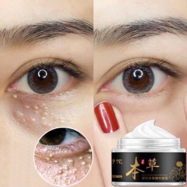 Kem xóa mụn thịt quanh mắt hết thâm giảm bọng mắt