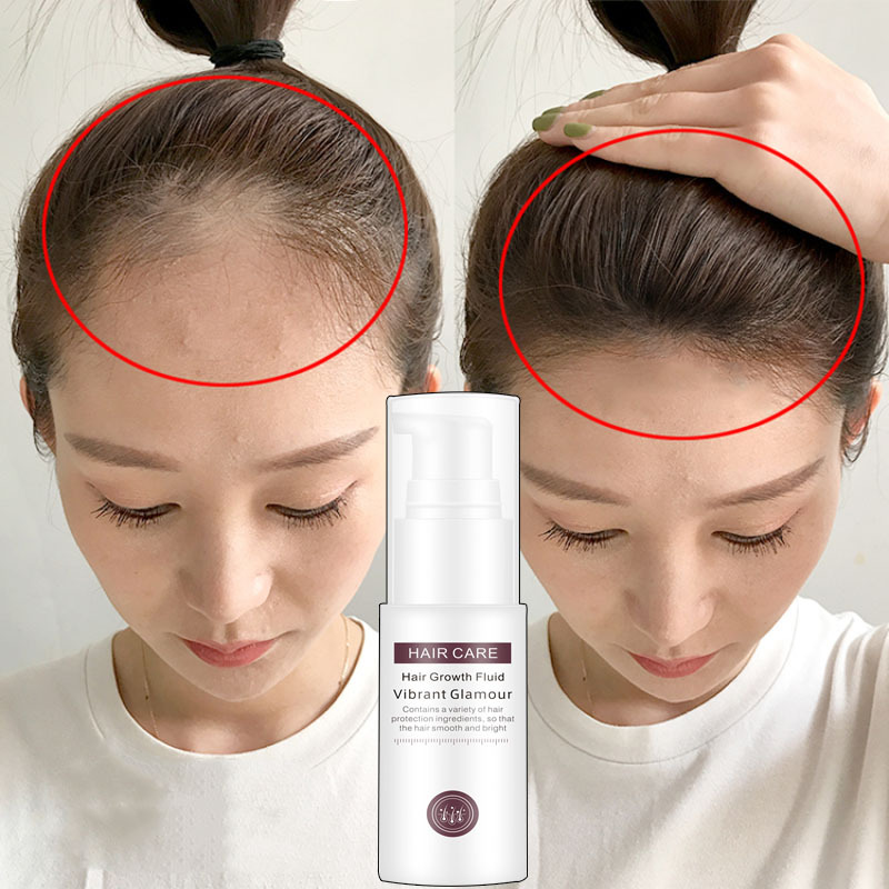 [HCM]Tinh dầu kích mọc tóc nhanh ngăn ngừa rụng tóc chai tinh dầutinh chất giúp tóc mọc nhanh chống rụng tóc Tinh chất tăng trưởng tóc nhanh Hair Grower Dầu xả tóc Tinh chất ngăn ngừa rụng tóc cho nam và nữ 30ML