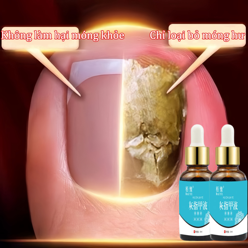 Dung dịch chăm sóc móng tay phục hồi nấm móng 20ml Dung dịch kháng nấm Tinh chất chăm sóc móng kháng khuẩn dung dịch khảng khuẩn Thảo dược tự nhiên loại bỏ nấm hiệu quả Loại bỏ Paronychia phục hồi bệnh nấm móng dùng chung cả nam và n