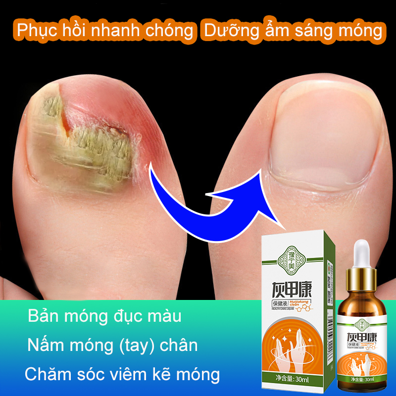 Serum đánh bay nấm móng, hư khoé, bọng móng,Loại bỏ nấm móng tay 30ml,Thoa nhẹ nhàng lên Phục hồi nhanh chóng Tạm biệt nấm móng Dung dịch kháng khuẩn thấm sâu và làm mềm móng bị bệnh,Làm sạch và diệt nấm trên giường móng
