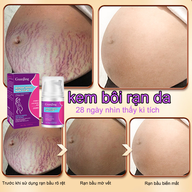 Kem làm mờ rạn da，Kem bôi rạn da rạn mỡ rạn sinh trưởng 60g Giúp Giảm Rạn Da, Mờ Sẹo, Đều Màu Da Khôi phục dịu nhẹ không kích ứng Phù hợp với nhiều loại da