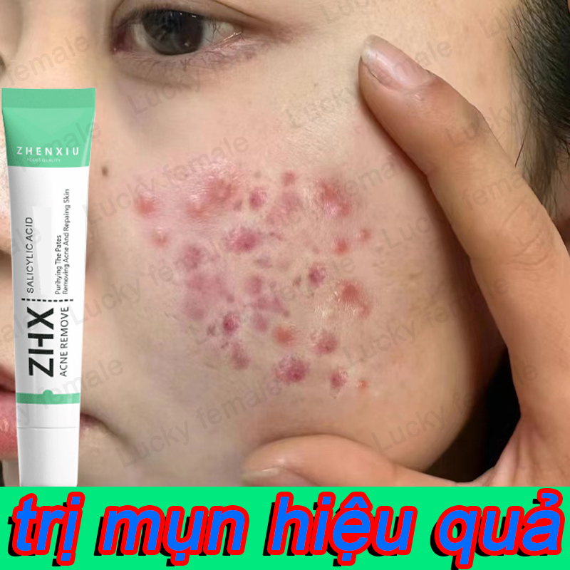Kem chấm mụn ZHX Gel ngừa mụn gel giảm mụn ngăn ngừa giảm nhanh mụn sưng đỏ mụn ẩn mụn bọc mụn viêm giảm thâm mụn 20g