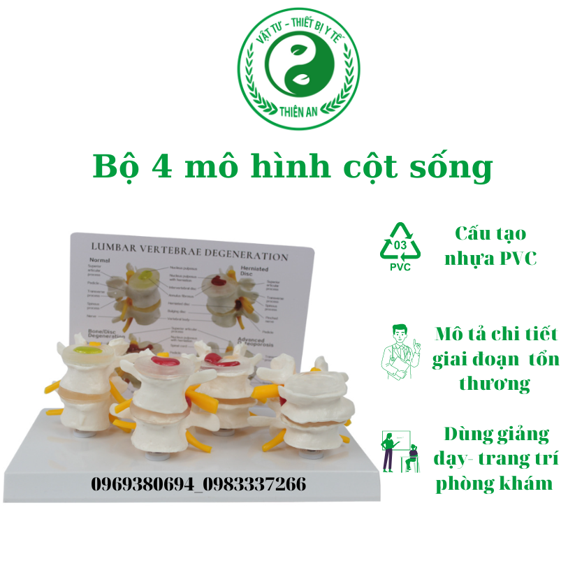 Bộ 4 mô hình PVC mô tả chi tiết tình trạng bệnh lý cột sống thắt lưng và thoát vị đĩa đệm