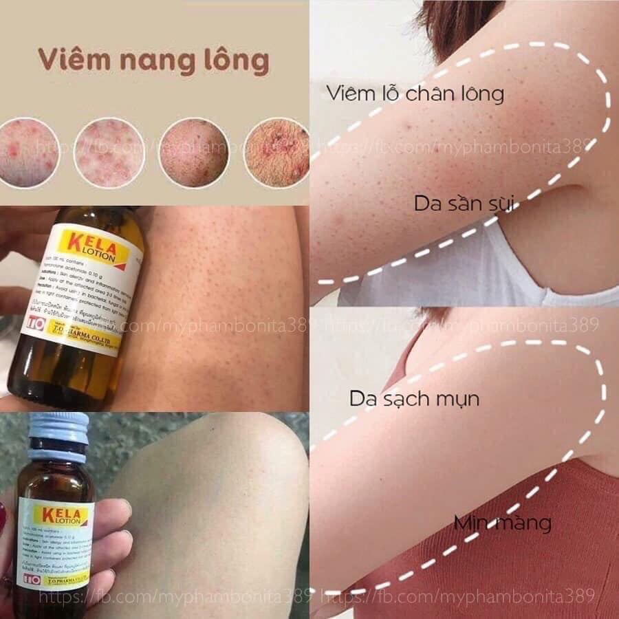 KELA LOTION THÁI LAN - xóa viêm lỗ chân lông