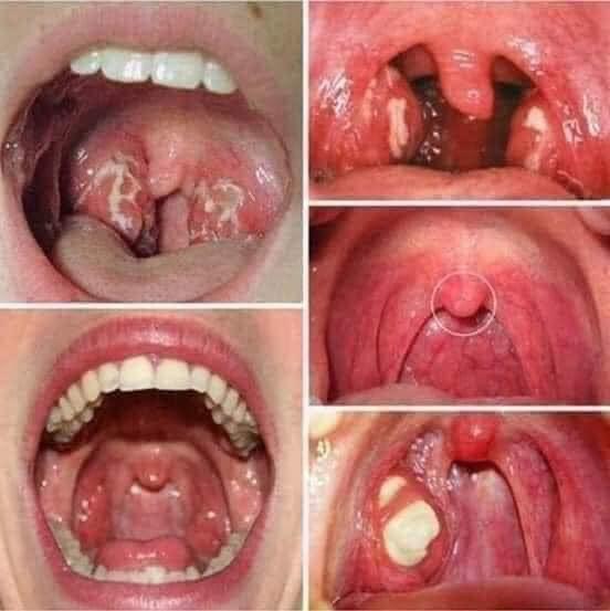 Viêm họng, amidan không còn là nỗi lo, chỉ cần khò họng với tinh dầu