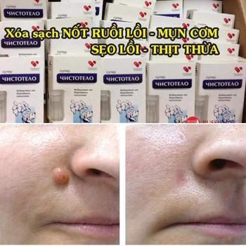 Gel tẩy nốt ruồi an toàn Gel Dvelinil tẩy nốt ruồi, mụn cóc, mụn thịt, sẹo lồi - Nhập khẩu Nga