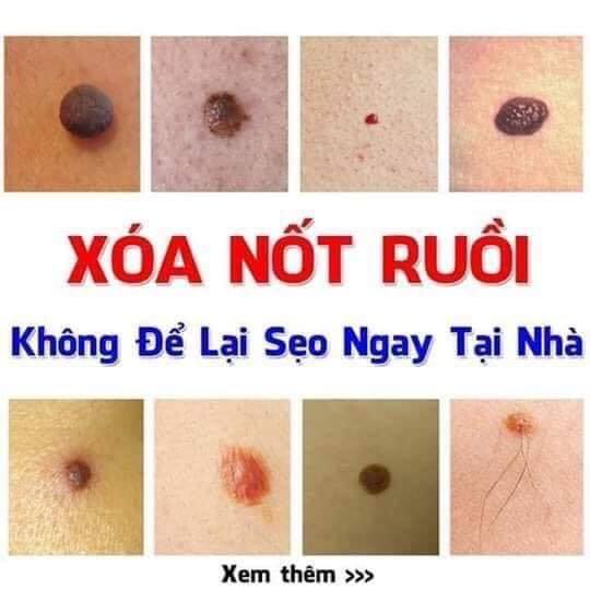 Tẩy Mụn Ruồi Mụn Thịt Mụn Cơm tại nhà Không để lại sẹo