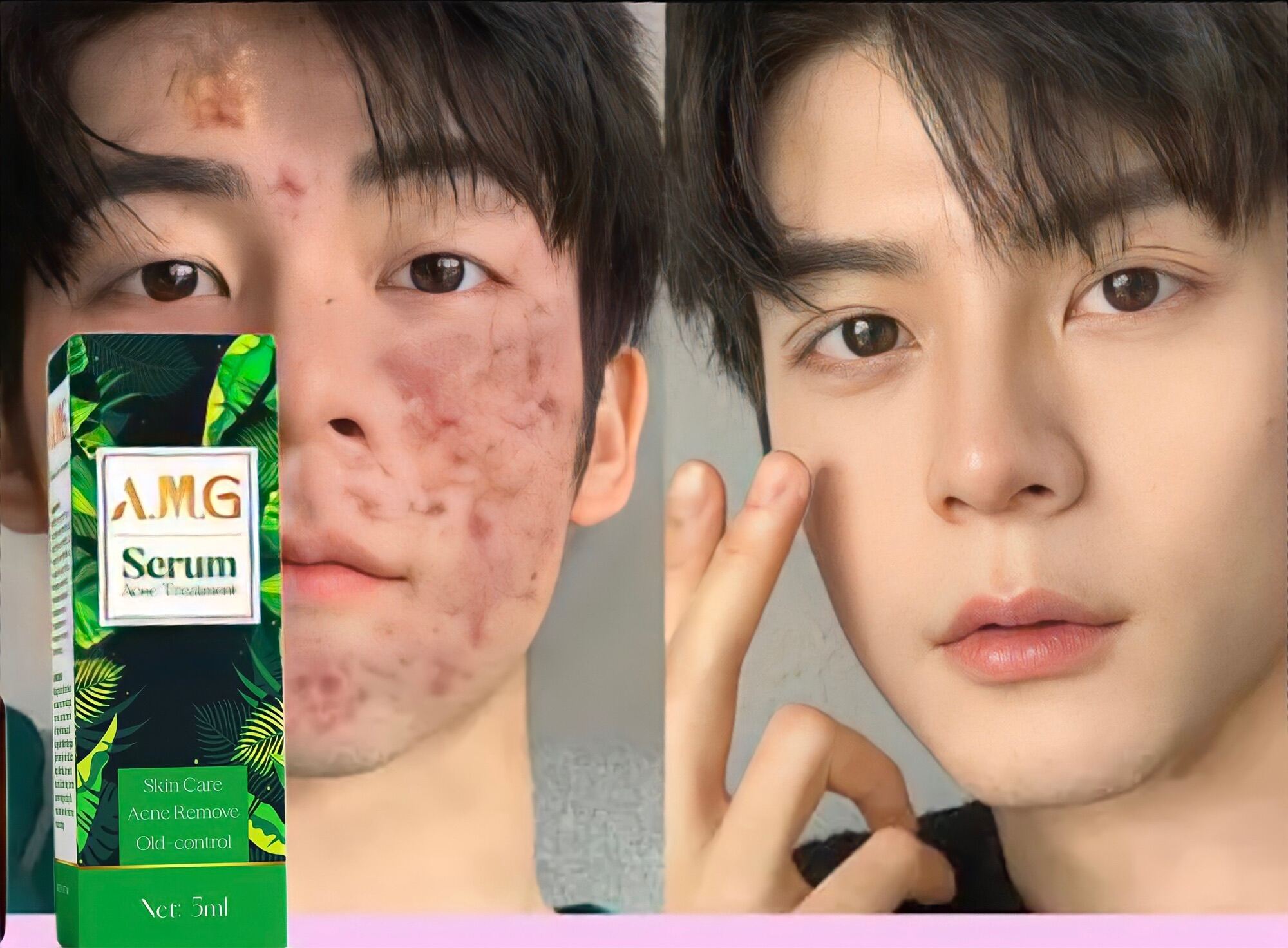 Serum mụn siêu tốc AGM 5ml
