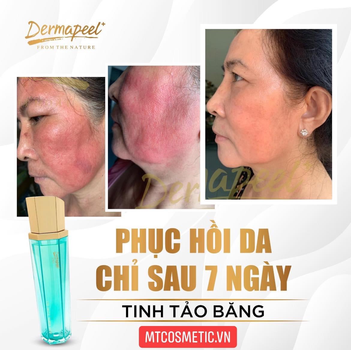 [MINI SIZE] TINH TẢO BĂNG DERMAPEEL - GIẢM TÌNH TRẠNG DA SƯNG ĐỎ NHANH CHÓNG - HẾT GÂN MÁU ĐỎ - HÀN QUỐC