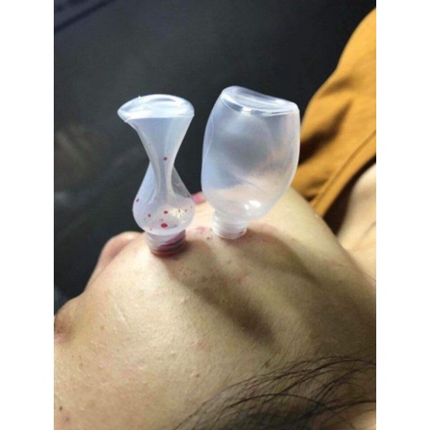 Ống hút mụn,hút máu bầm,lọ bóp ỐNG dùng trong Spa