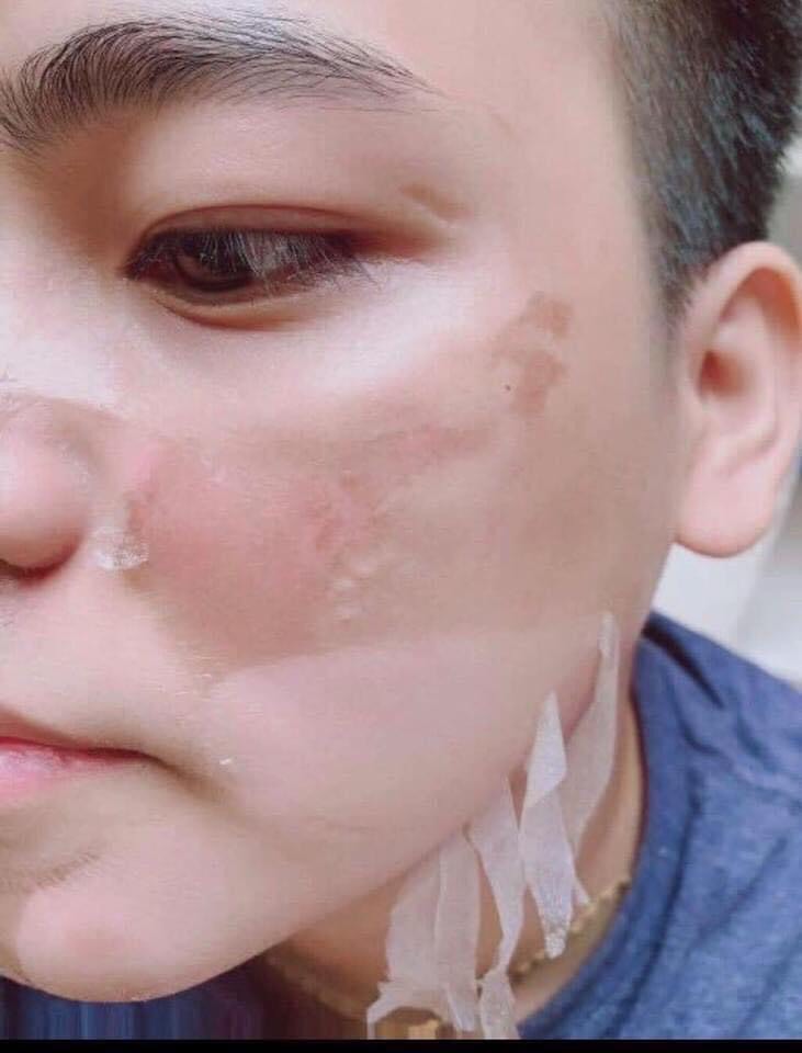 Peel da TCA 50% Đặc Trị Sẹo Rỗ, đánh bay Mụn, Hết thâm, nám, lỗ chân lông to, da dầu, rạn, sẹo lồi, Làm Hồng Ti, Hết Thâm Bẹn Nách, làm trắng mịn da