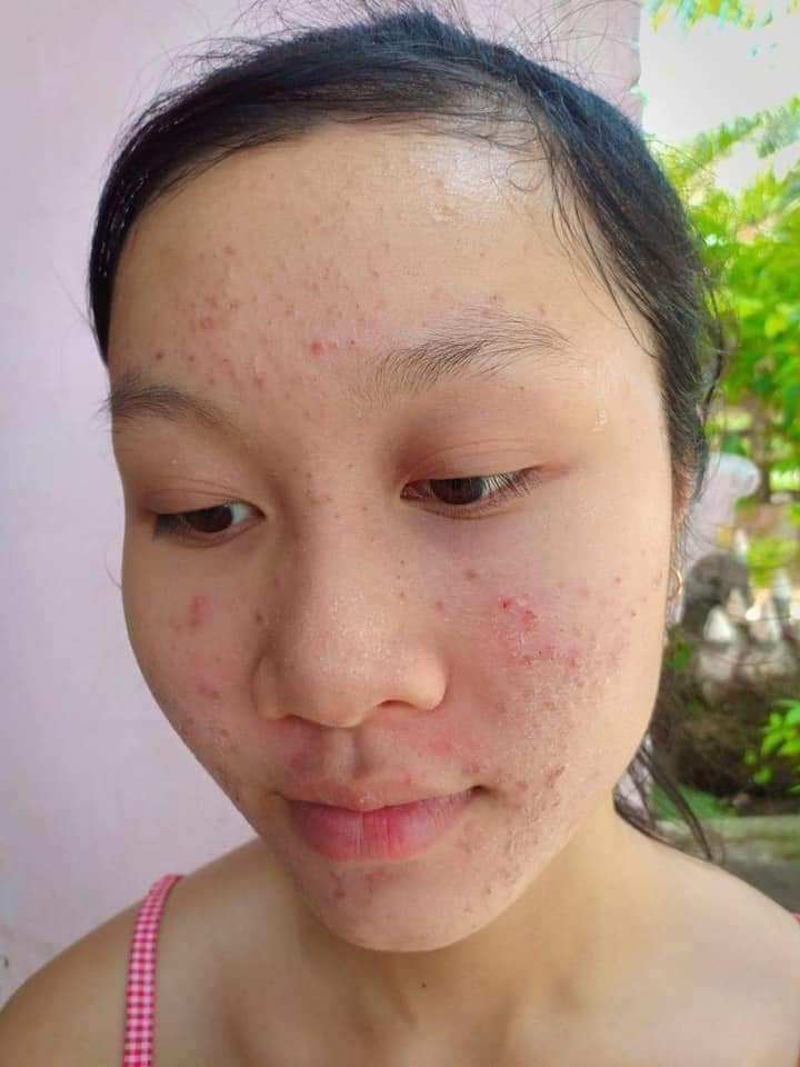 kem face mụn huỳnh đỗ