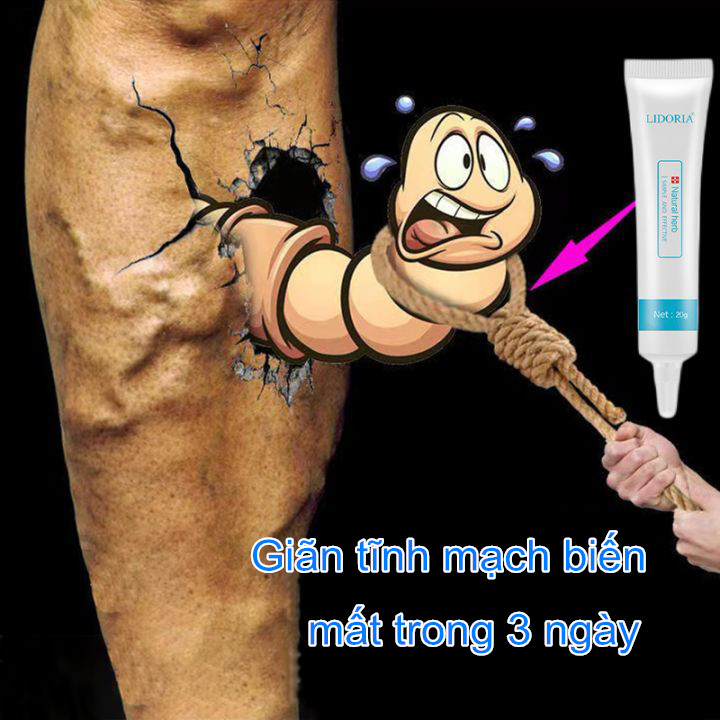 Kem loại bỏ giãn tĩnh mạch Chăm sóc sức khỏe hiệu quả kem mỡ bôi giãn tĩnh mạch Kem xoá giãn tĩnh mạch Loại bỏ tĩnh mạch Kem xoá giãn tĩnh mạch hiệu quả