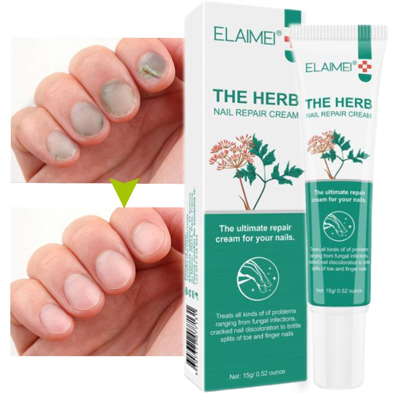 Phục hồi móng tay,Móng kháng khuẩn15g, Phục hồi móng chân,giải quyết tình trạng móng chân bị hoại tửhiệu quả nhanh dùng cho nam và nữ, loại bỏ nấm móng gãy móng chống