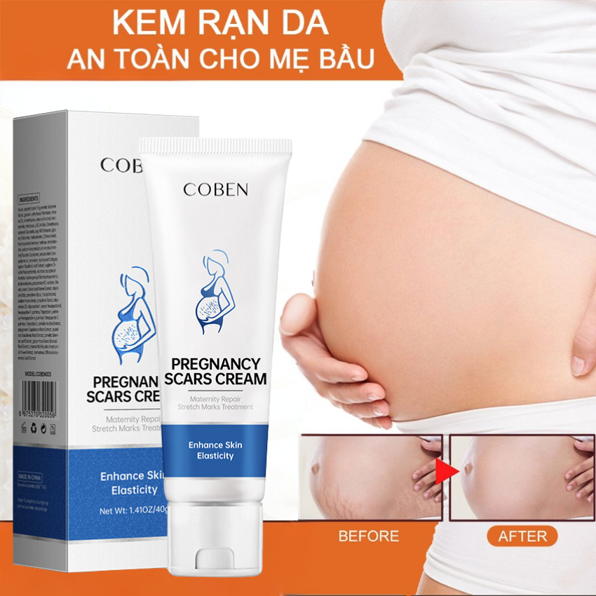 Kem trị rạn da coben chăm sóc da cho phụ nữ mang thai, làm mờ vết rạn bụng, dưỡng ẩm, phục hồi độ đàn hồi cho da