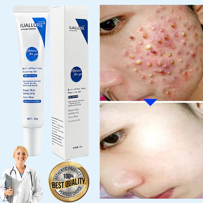 Kem làm sạch mụn chuyên sâu IUALLURE 20g Xóa mụn nhanh chóng Kem triệt mụn thảo dược Tinh chất gel xoá mụn gel xoá mụn thảo dược Gel chuyên dụng cho cơ bắp mụn trứng cá