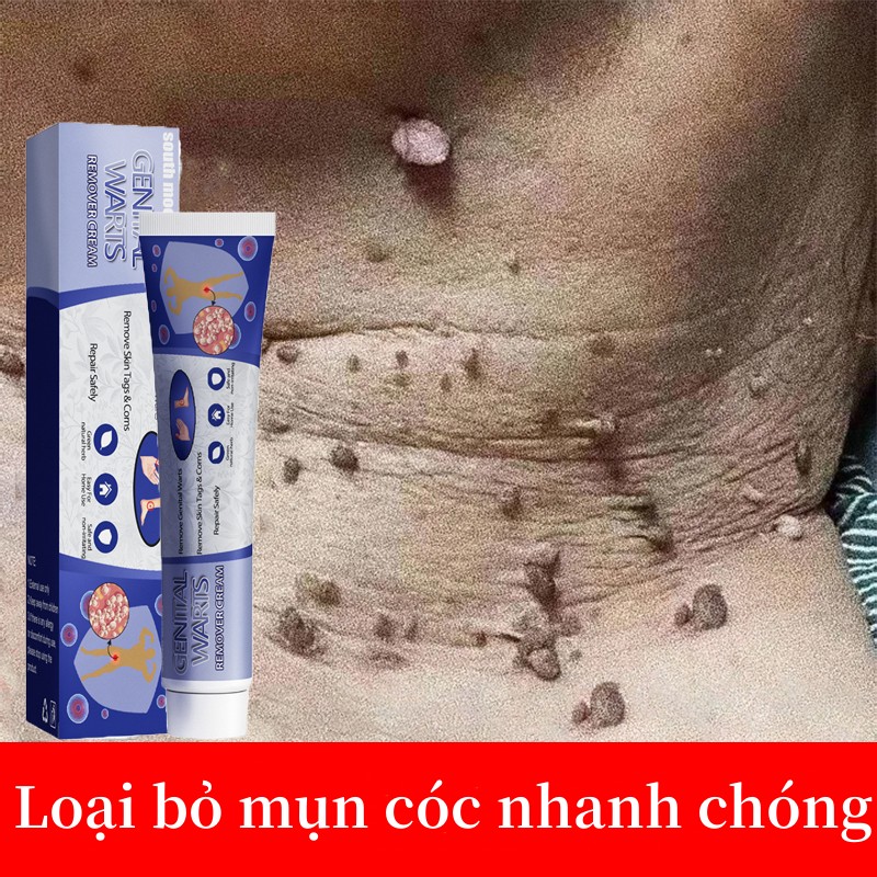 South Moon Wart Removal Cream Kem mụn cóc 20g loại bỏ mụn cóc tẩy nốt ruồi mụn cóc phục hồi gel làm mờ sẹo