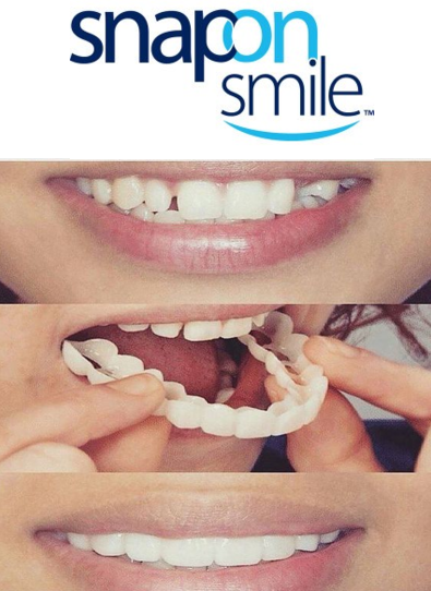 Răng giả Snap on smile cho nụ cười thêm tươi hàng thật chuẩn loại 1
