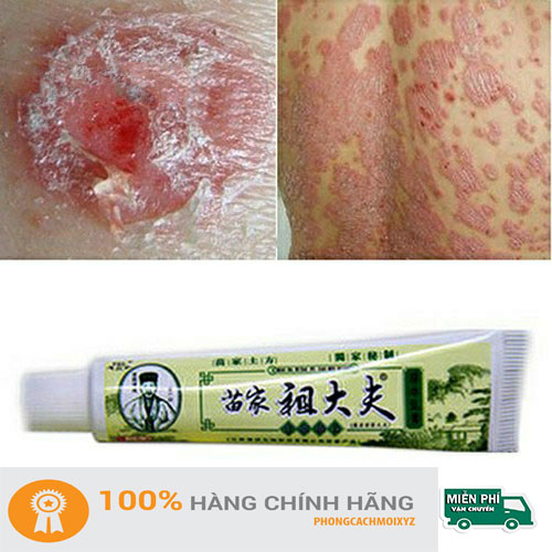 Kem bôi Viêm Da Cơ Địa, Vảy nến Hoàng Cung Xanh - Y học trung Hoa