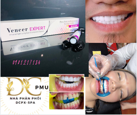 men sứ ĐỨC VENEES bxl (trám răng sứ) màu trắng trong tự nhiên