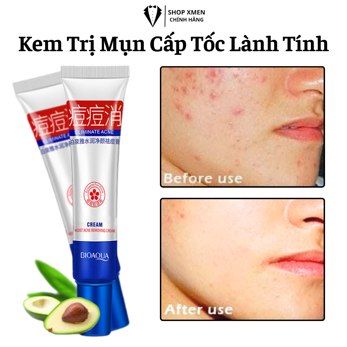 Kem chấm hết sạch mụn ẩn mụn viêm mụn sung mụn bọc mụn đầu đen trên da phục hồi vết thâm mụn nhanh chóng