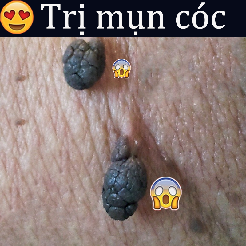 Kem trị mụn thịt thuốc xóa mục ruồi wart remover ointment thuốc trị nốt ruồi mụn thịt tẩy nốt rồi nốt rồi vĩnh viễng chấm mụn cóc