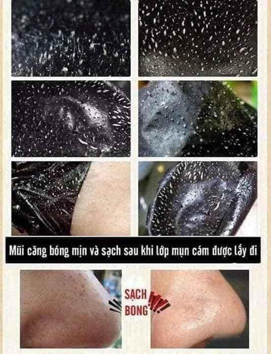 Gel Lột Mụn Than Tre Hoạt Tính, Lột Sạch Mụn Cám, Mụn Đầu Đen