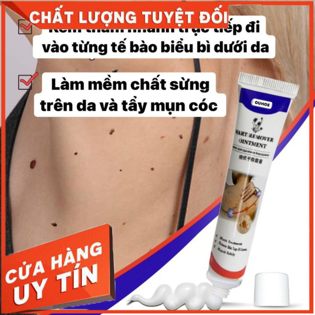 Kem Wart Remover Ouhoe Nội Địa 20g Khử Mụn Cóc , Mụn Thịt , Nốt Ruồi Hiệu Quả , Sản Phẩm Chuyên Dùng