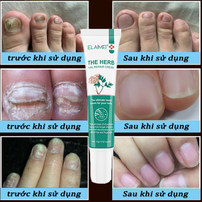Sửa móng tay nuôi dưỡng Sửa chữa móng tay, làm móng tay mượt mà tinh chất phục hồi móng Kem sửa chữa móng tay - móng chân bị hư hại - móng tay bị hư hại Kem dưỡng phục hồi chăm sóc móng