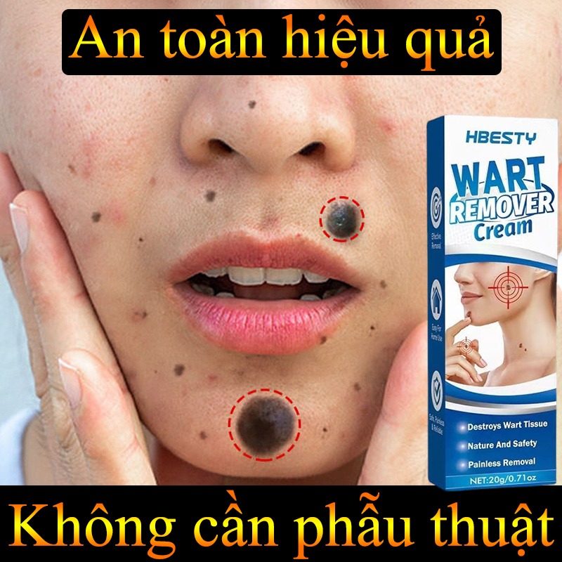 Serum tẩy nốt ruồi xóa mụn ruồi trên mặt 20ml kem tẩy nốt ruồi trên mặt tẩy xoá nốt ruồi , tàn nhang, mụn cóc , mụn thịt hiệu quả nhanh, Sẹo Lồi không để lại sẹo, Tẩy nốt ruồi xóa mụn ruồi tại nhà an toàn hiệu quả
