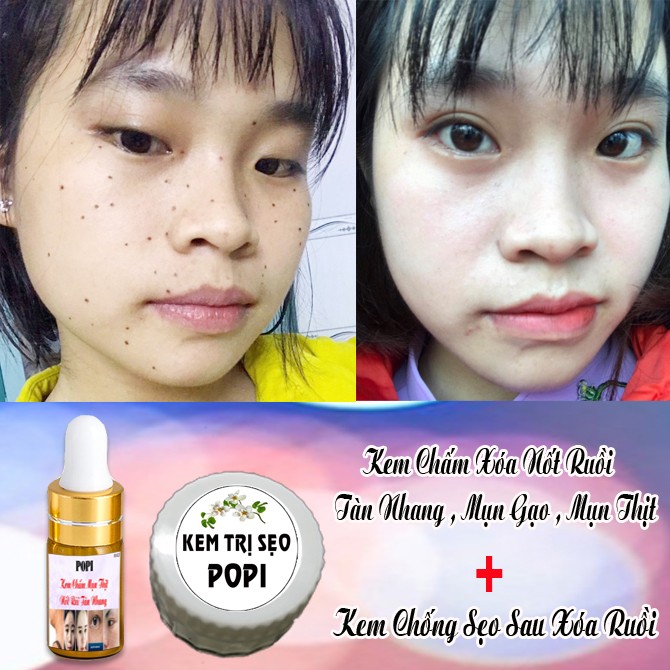 Combo Kem Phá Tàn Nhang Nốt Ruồi Mụn Thịt & Kem Chống Sẹo Popi