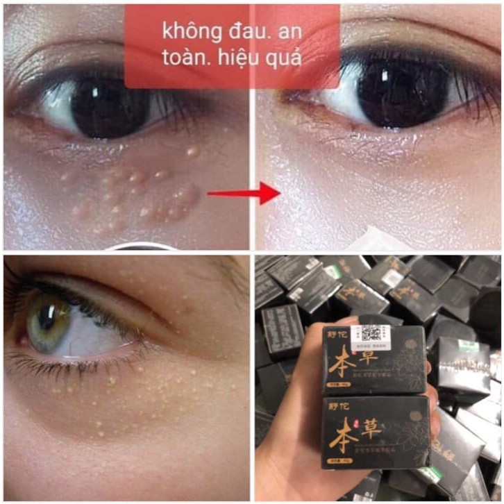 Kem Mụn Thịt Gentian Eye Cream - Giảm Quầng Thâm Bọng Mắt