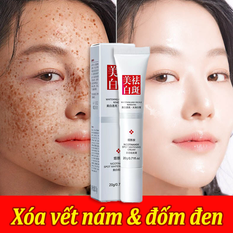 Loại bỏ tàn nhang nhanh chóng Kem làm trắng da loại bỏ tàn nhang Loại bỏ