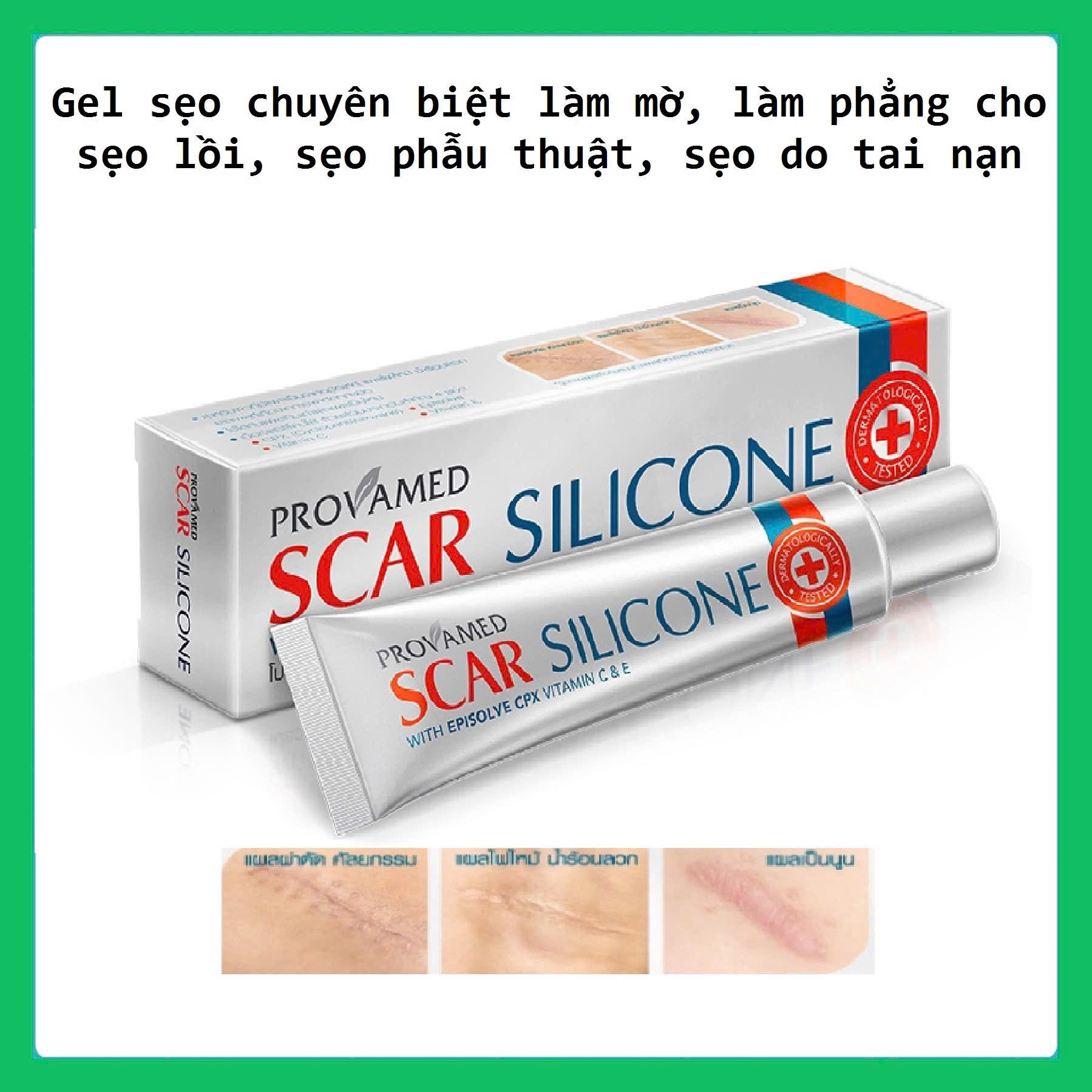 Gel Sẹo Chuyên Biệt Cho Sẹo Lồi, Sẹo Phẫu Thuật, Sẹo Do Tai Nạn Provamed Scar Silicone 10g