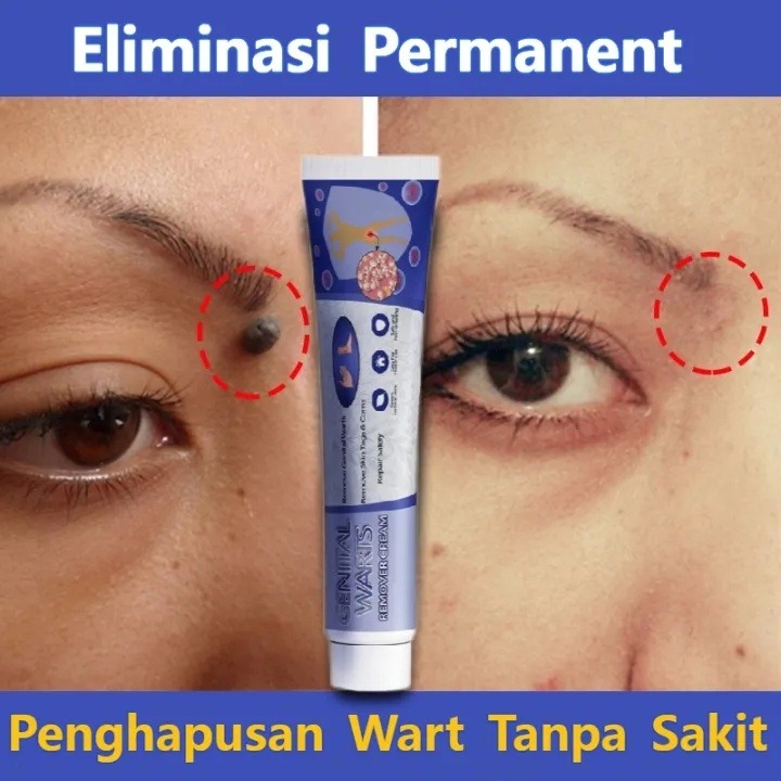 Kem Bôi Rụng Hết Sạch Mụn Thịt Thừa, Mụn Cóc, Mụn Nốt Duồi Và Các Mụn Li Ti Quanh Mắt loại bỏ mụn cóc thông thường ,An toàn, không gây kích ứng, dễ dàng và nhanh chóng để loại bỏ 祛疣膏20g