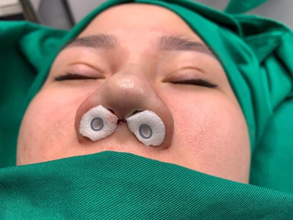Bông cầm máu mũi có ống thở