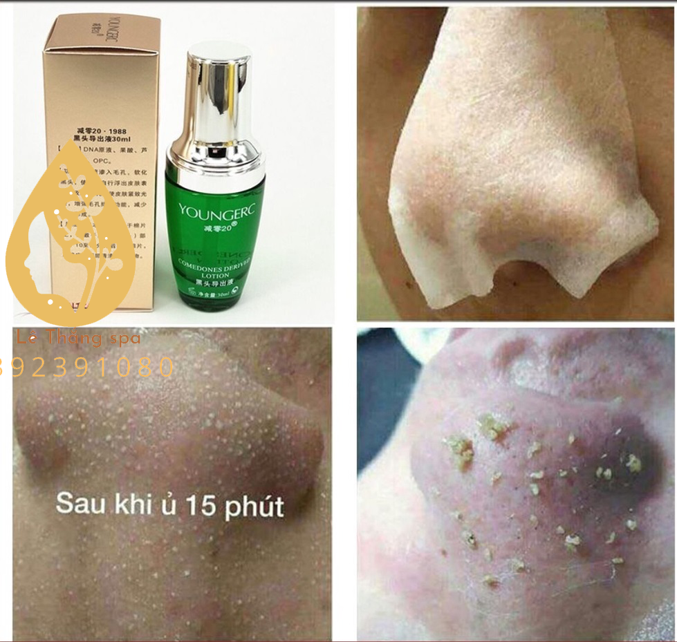 Tinh chất ủ mụn cám, mụn đầu đen siêu nhạy YoungerC