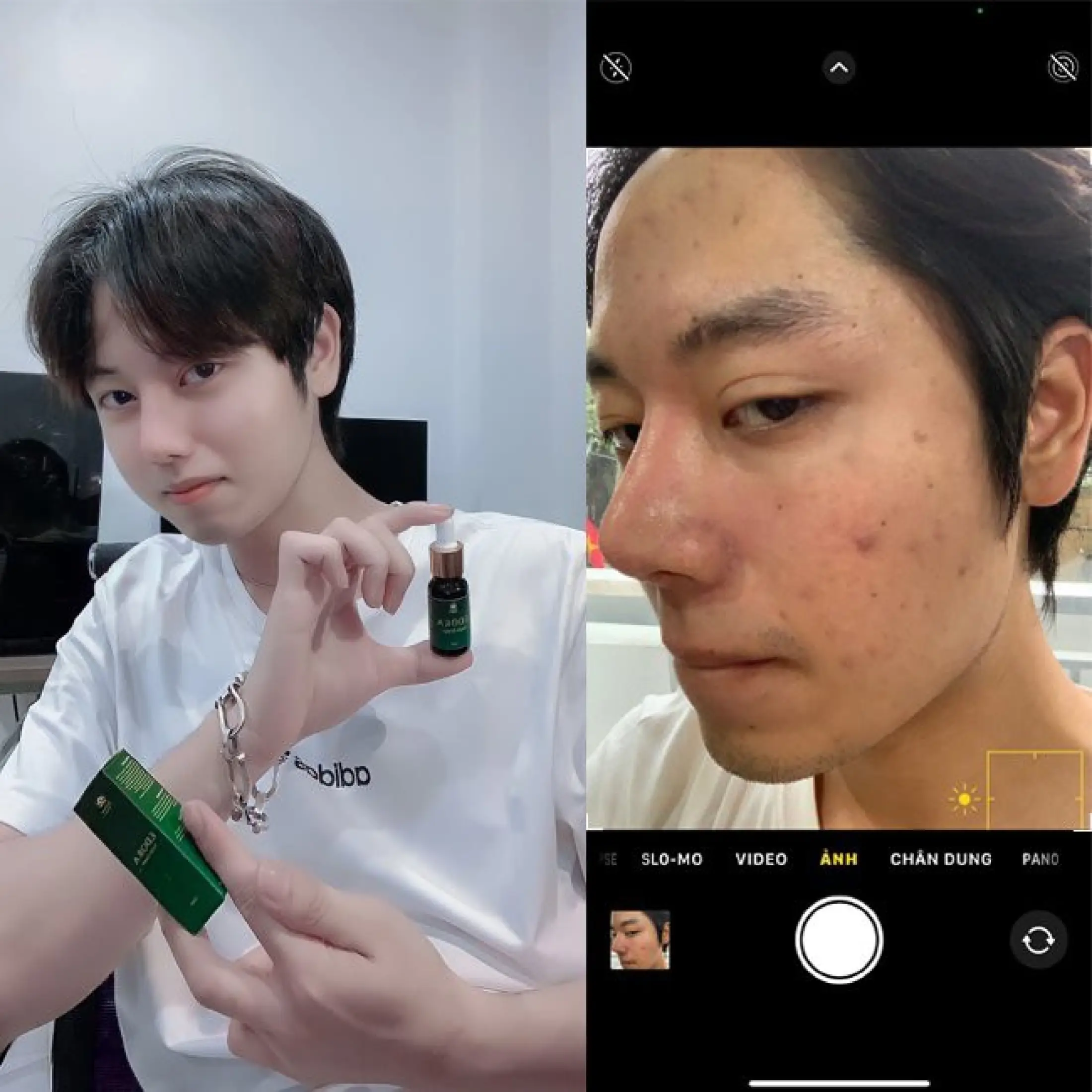 Serum quét sạch mụn Edora